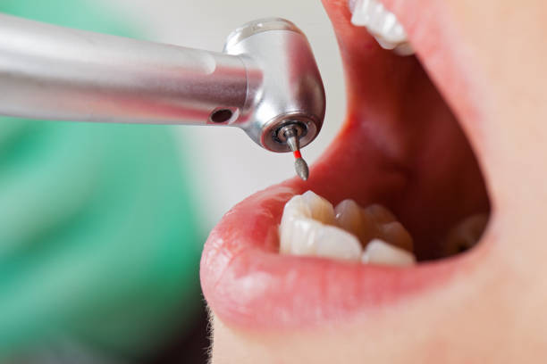 Best Urgent Care for Lost Fillings or Crowns in Aberdeen, MS